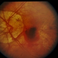 degenerative myopia retina