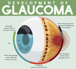 development of glaucoma