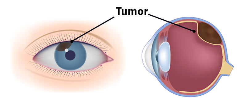 What is eye cancer?