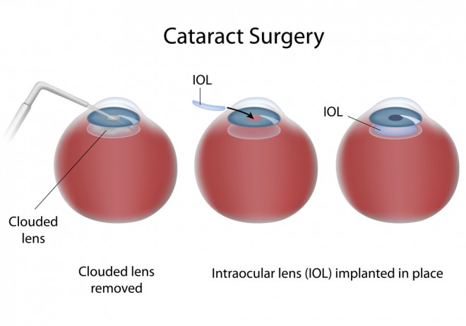 Cataract Surgery And Keratoconus Discovery Eye Foundation