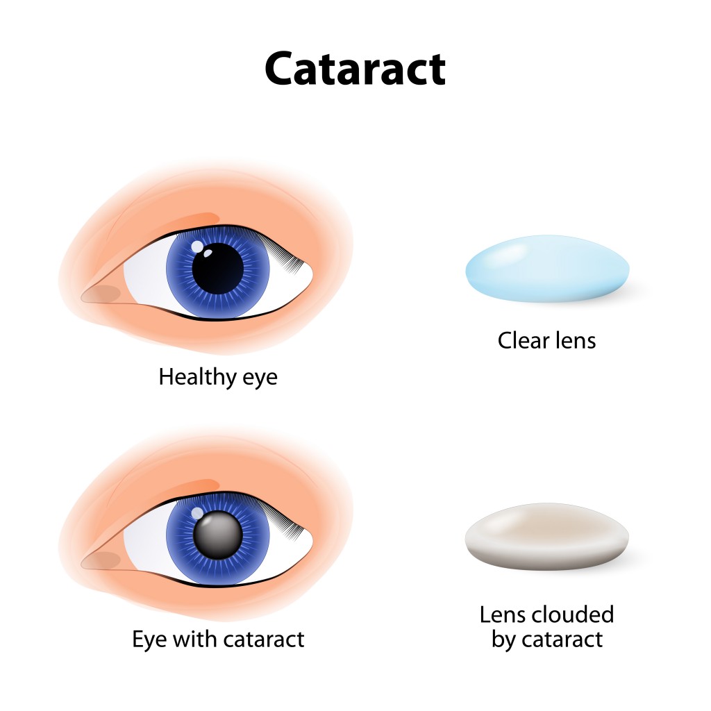 double vision and cataracts
