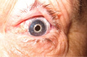 Eye with Boston keratoprosthesis
