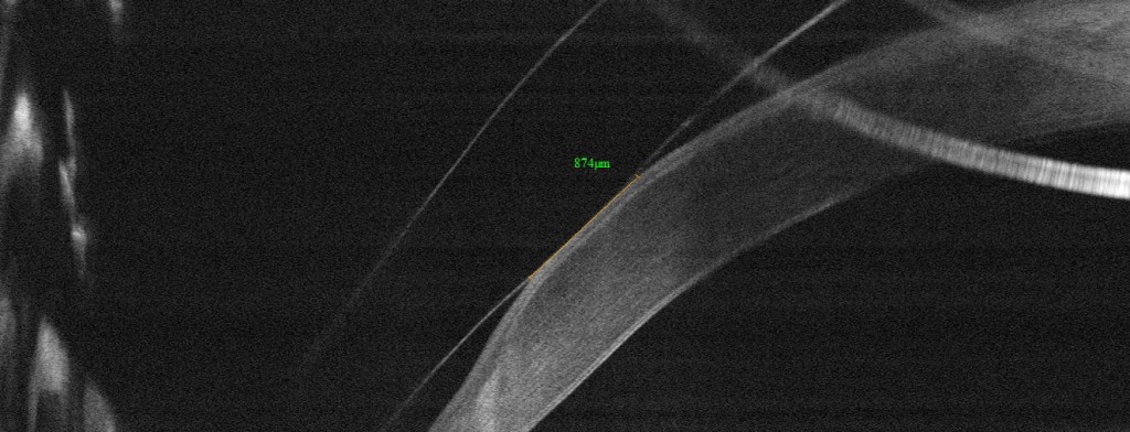 Figure 2.  OCT image of the periphery of a scleral lens on a patient with pellucid marginal degeneration.  The lens contacts the cornea over an area of 0.87mm long.  These types of measurements help guide decision making in modifying the lens fit and were impossible before the advent of this technology.
