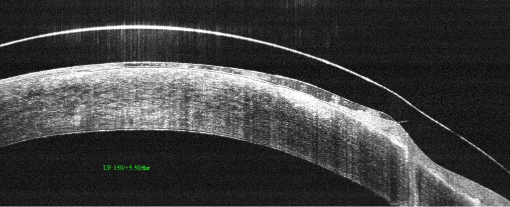 Figure 3.  Hybrid lens on a highly irregular eye after corneal transplant.  The point of contact of the soft skirt with the cornea is visible to the right of the image.