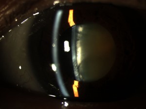 Figure 1 – Slit-lamp photo of a visually significant cataract.