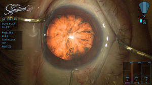 Figure 2 – Intraoperative photo during cataract surgery (prior to cataract removal).