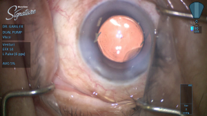 Figure 3 – Intraoperative photo during cataract surgery (after implantation of an IOL).