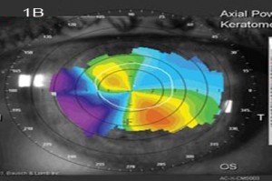 1B - toric intraocular lenses