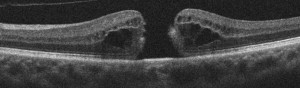 Hole - Macular Pucker and Macular Hole