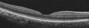 Normal - Macular Pucker and Macular Hole