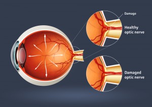 optic nerve - glaucoma awareness