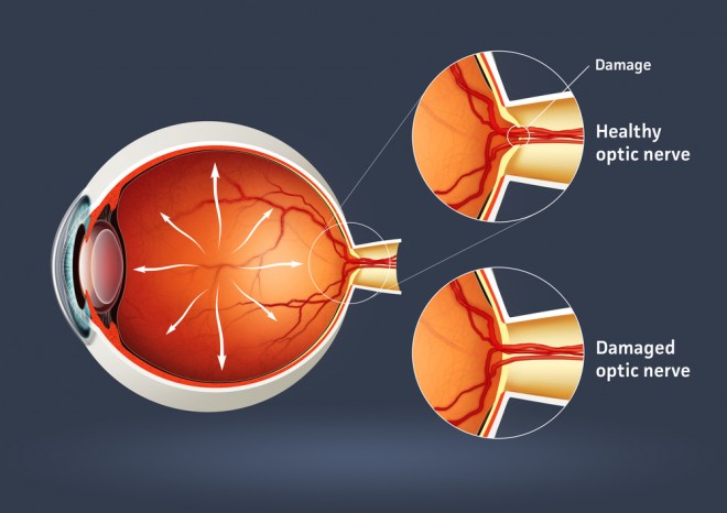 what-is-the-optic-disc-with-pictures