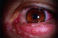 Understanding Ocular Herpes Discovery Eye Foundation